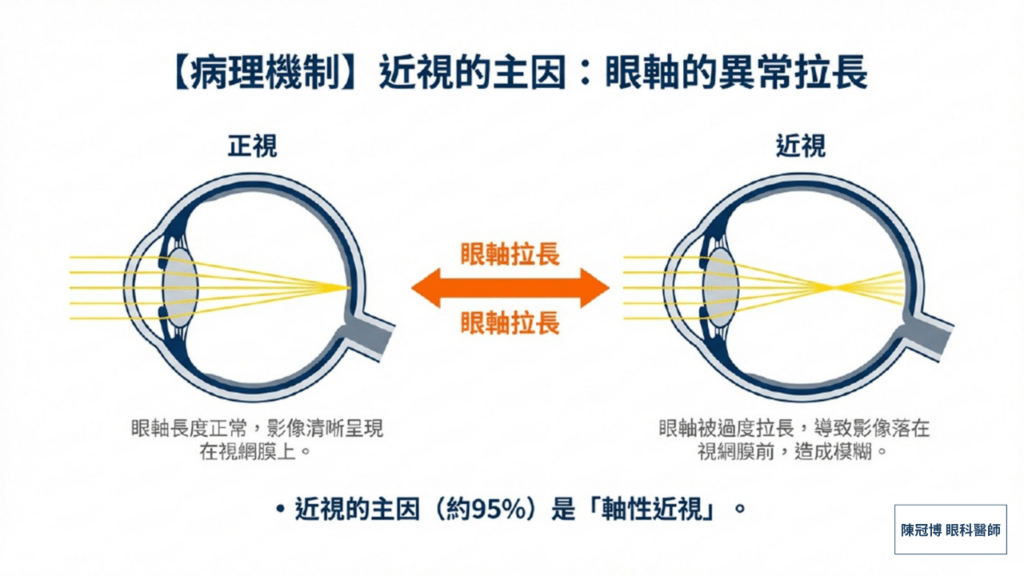 Myopia progression axial length elongation monitoring